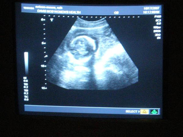 60_Ruth's_ultrasound